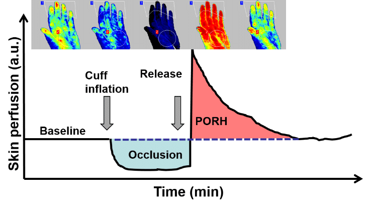 Hyperémie réactive post-occlusive - Dysfonctionnement Endothélial
