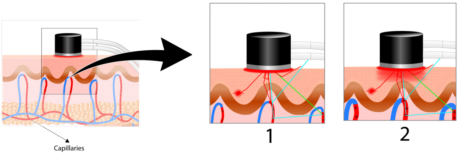 Illustration montrant comment évaluer la microcirculation cutanée à l’aide d’une sonde chauffée - Laser Doppler à Contrôle de Température